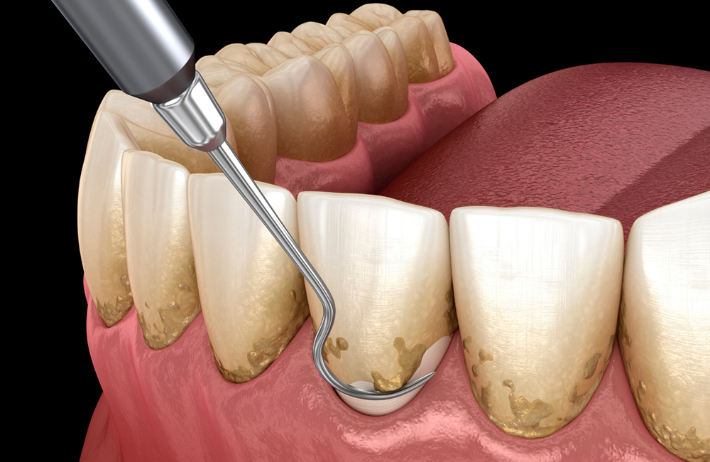 Periodoncia